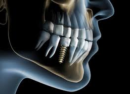 Dental implants patient