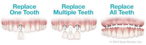 dental implants patients