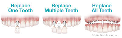 Dental Implants - Moorestown, NJ & Medford, NJ - Restore Your Smile