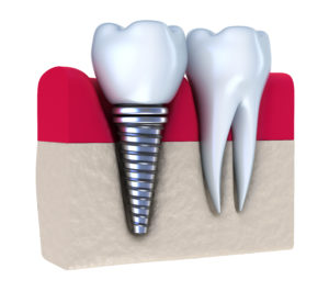 couple with dental implants