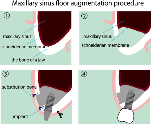 Preparation For Dental Implants With A Sinus Augmentation- Medford, NJ And Moorestown, NJ