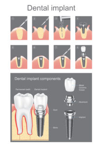 Dental Implant - Houston,TX - Solution For Missing Teeth