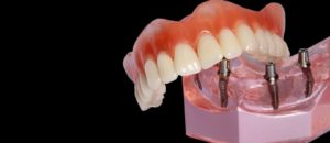 Implant Supported Denture Display