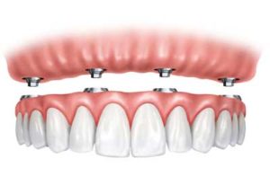 ball retained dentures oxon hill md