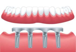 bar retained denture oxon hill md