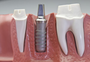 Dental implant post model