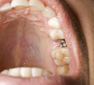 Dental Implants upper left 