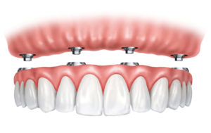implant supported dentures in chandler az
