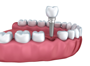 dental implants upper left woodbury mn 