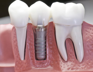 dental implants model 