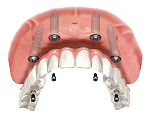 all-on-4 dental implants 