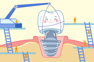 Cartoon image of dental implant crown being placed by a crane