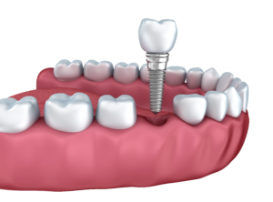 dental implants dallas tx